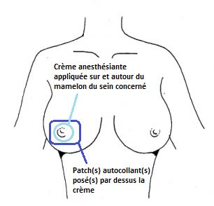 Schéma de présentation de la procédure de scintigraphie dans le cas du Ganglion Sentinelle